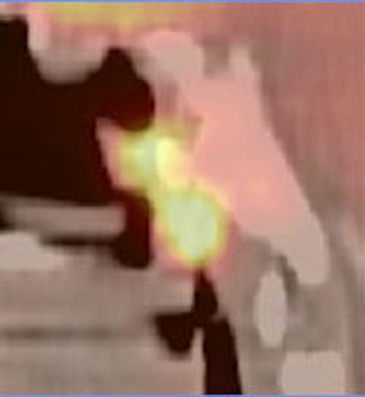 HN_cone_fusion.JPG (9054 bytes)