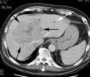 Hepatoma Ct
