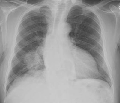 Hoa_cxr.jpg (12913 bytes)