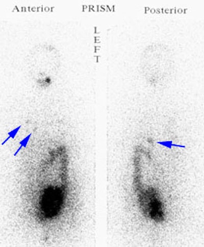 Hurthle_I131.JPG (25235 bytes)