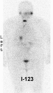 I 123 Neg2