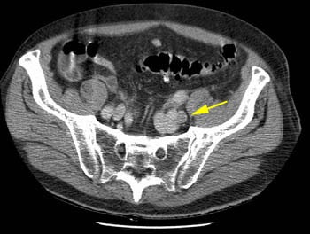 Iliac clot.jpg (26293 bytes)
