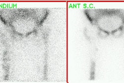 Infected Prosthesis