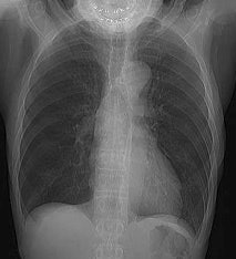 Intercostal Cxr