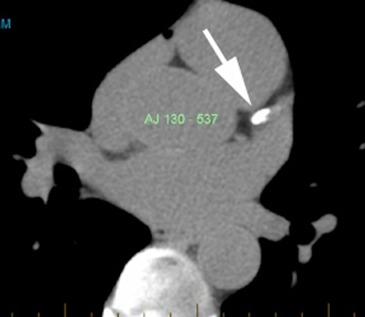 テスト Cardiac > Adultdz > CACalc | AuntMinnie