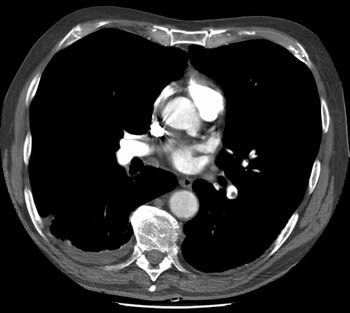 /ScottWilliamsMD2/CHEST/Vascular/PE/Images/Iliac%20DVT/lll.jpg (21076 bytes)