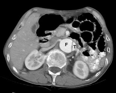 /ScottWilliamsMD2/CHEST/Vascular/Dissection/Images/CT_false_true/larger_lumen.jpg (21738 bytes)