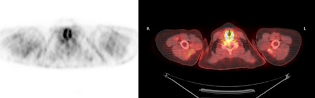PET > PET tumor imaging > General | AuntMinnie
