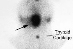 Lingual_thyroid.JPG (15196 bytes)