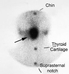 Lingual_thyroid.JPG (15196 bytes)