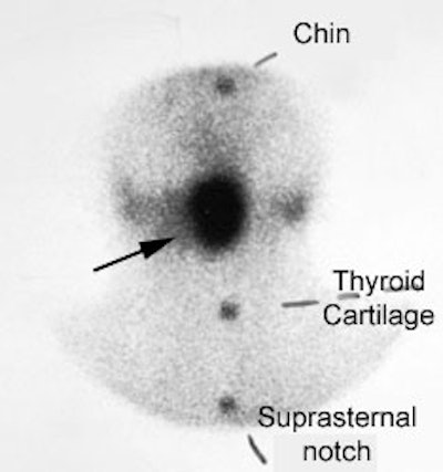 Lingual_thyroid.JPG (15196 bytes)