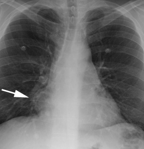 Lipoma Cxr