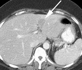 Liver Ct