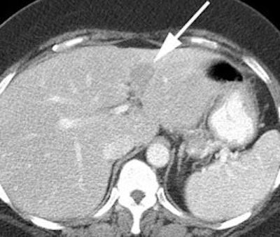 Liver Ct