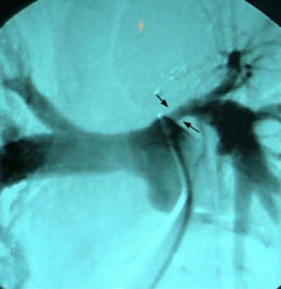 Lt Pa Encased On Angio S