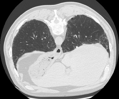 Lung prone small.JPG (80572 bytes)