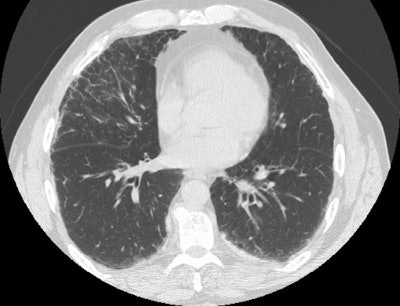 Lung supine small.JPG (68341 bytes)