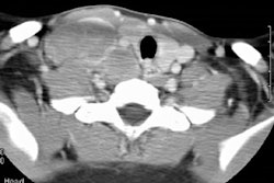 Lymphoma2 0001