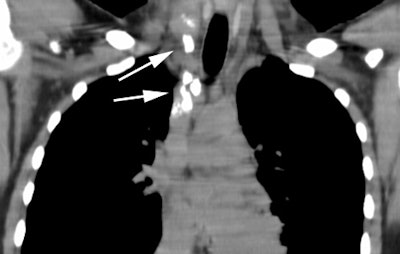 Lymphoma Post Rx 0001