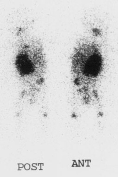 MIBG_Neuroblastoma1.jpg (18380 bytes)