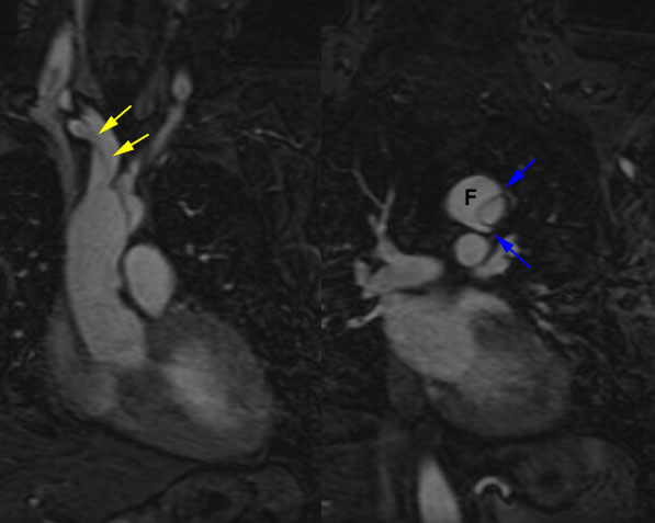 /ScottWilliamsMD2/CHEST/Vascular/Dissection/Images/TypeA/Case1/mri.jpg (36694 bytes)