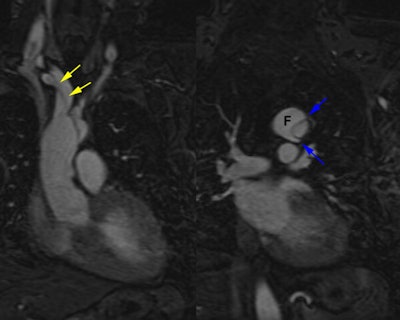 /ScottWilliamsMD2/CHEST/Vascular/Dissection/Images/TypeA/Case1/mri.jpg (36694 bytes)