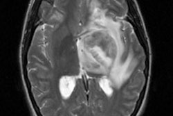 Mr Brain Tumor