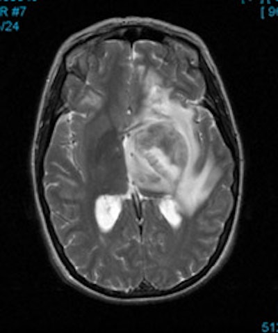 Mr Brain Tumor