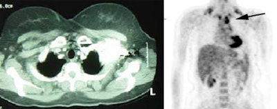 Melanoma Nodes