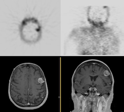 Meningioma Sestamibi