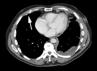 Mesothelioma Ct