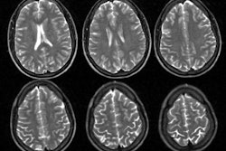 Neuro Lyme Mr