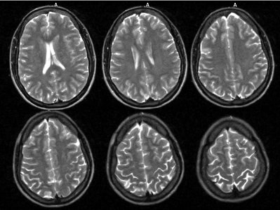 Neuro Lyme Mr