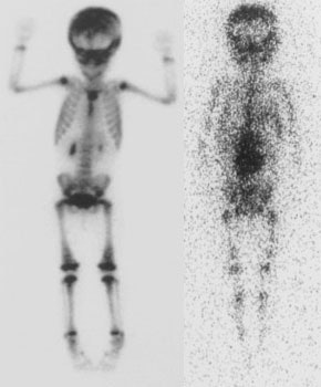 Neuroblastoma2.JPG (22434 bytes)