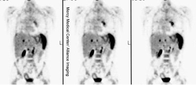 NonHodgkins_splenicdz.JPG (20978 bytes)