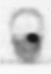 Octreotide_SPECT1.jpg (5487 bytes)