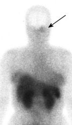 Octreotide_WB_sm.jpg (8358 bytes)