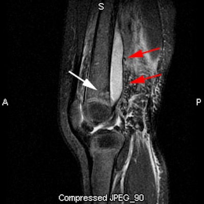 Osteo1 Mri