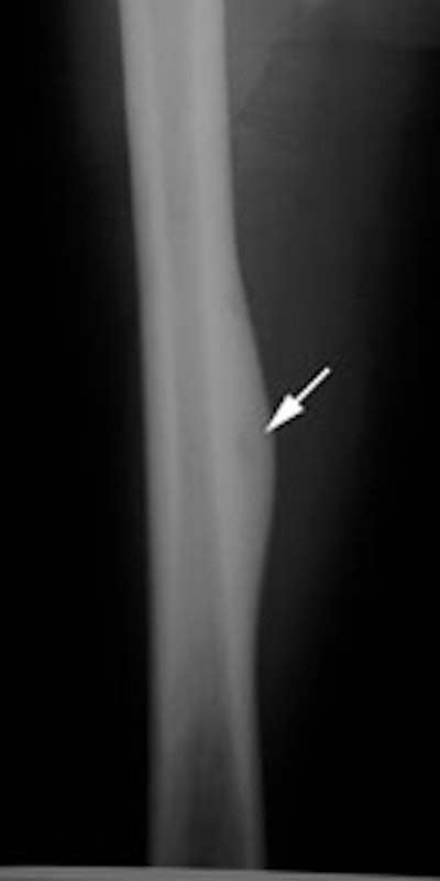 Osteoid_osteoma_PF_sm.JPG (5415 bytes)