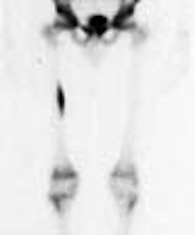 Osteoid_osteoma_WB.JPG (3092 bytes)