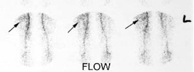 Osteoid_osteoma_flow_sm.JPG (8220 bytes)