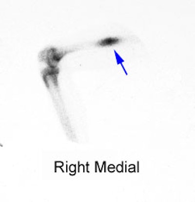 Osteoid_osteoma_medial.JPG (8687 bytes)