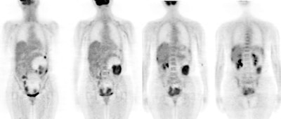 Ovarian1