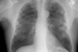 Pa Cxr Small