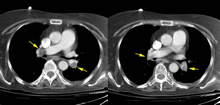 PE on CT.JPG (44513 bytes)