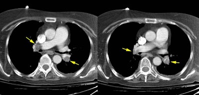 PE on CT.JPG (44513 bytes)