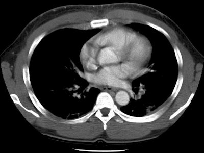 /ScottWilliamsMD2/CHEST/Vascular/PE/Images/Case2/pe1.jpg (81970 bytes)