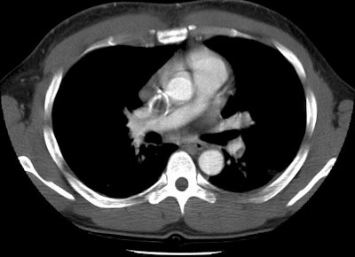 /ScottWilliamsMD2/CHEST/Vascular/PE/Images/Case2/pe2.jpg (77338 bytes)