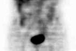 /ScottWilliamsMD2/NucMed/Tumor/CEA-scan/Cytogen%20cases/pet1.jpg (1203 bytes)