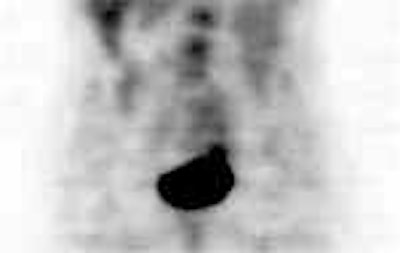 /ScottWilliamsMD2/NucMed/Tumor/CEA-scan/Cytogen%20cases/pet2.jpg (1202 bytes)